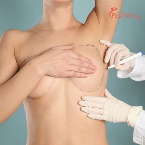 Breast Augmentation in Thailand: Achieve Your Desired Look with Affordable Care for Australian Women